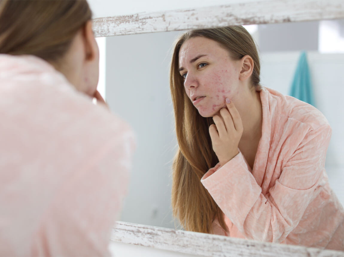 жіноча - шкіра, схильна до акне 