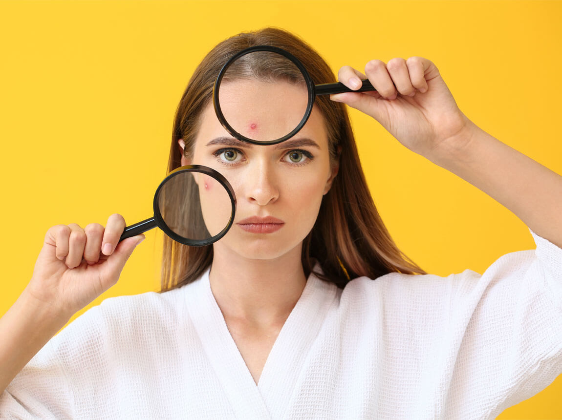 у жінок - акне 