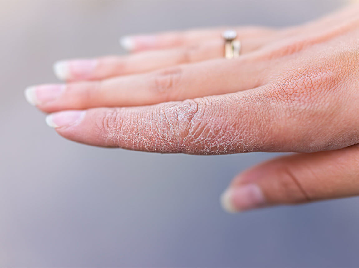 потріскана шкіра на руках 