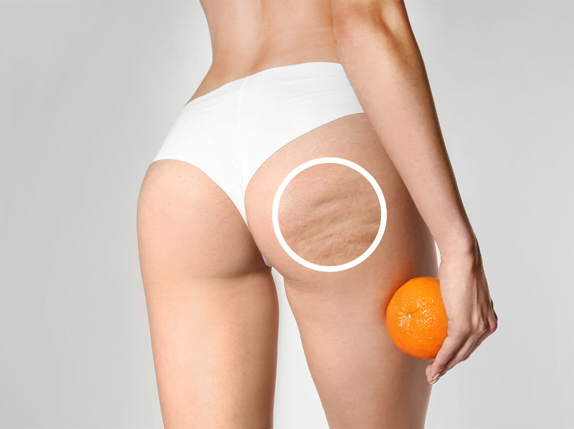 жінка - целюліт 