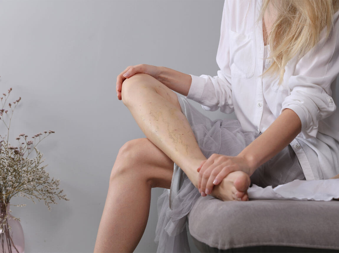 жінки - варикозне розширення вен на ногах 