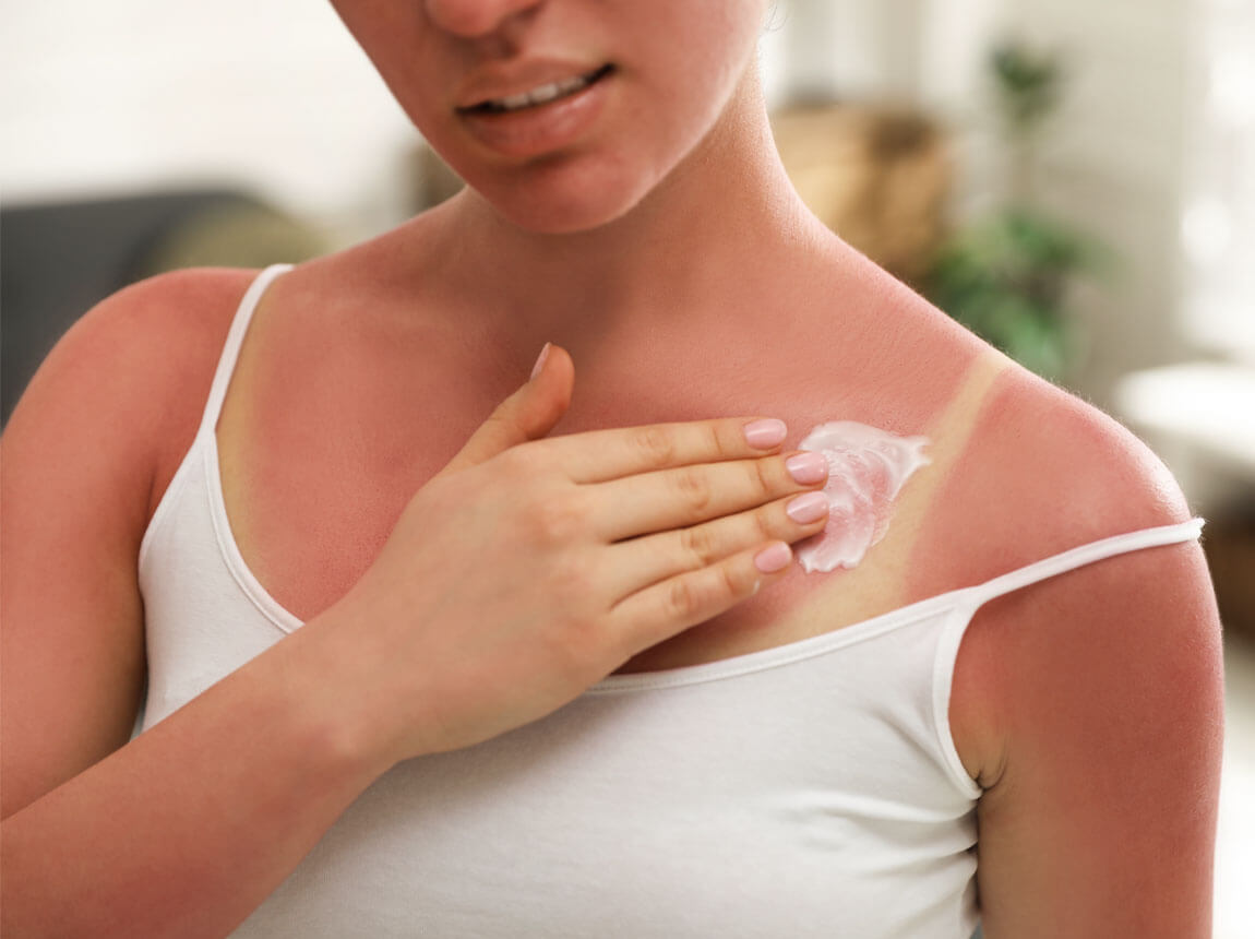 жінка - сонячні опіки