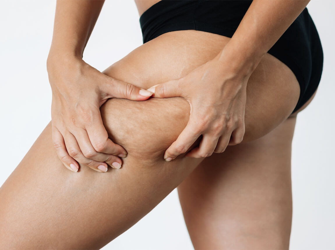 жінка - целюліт