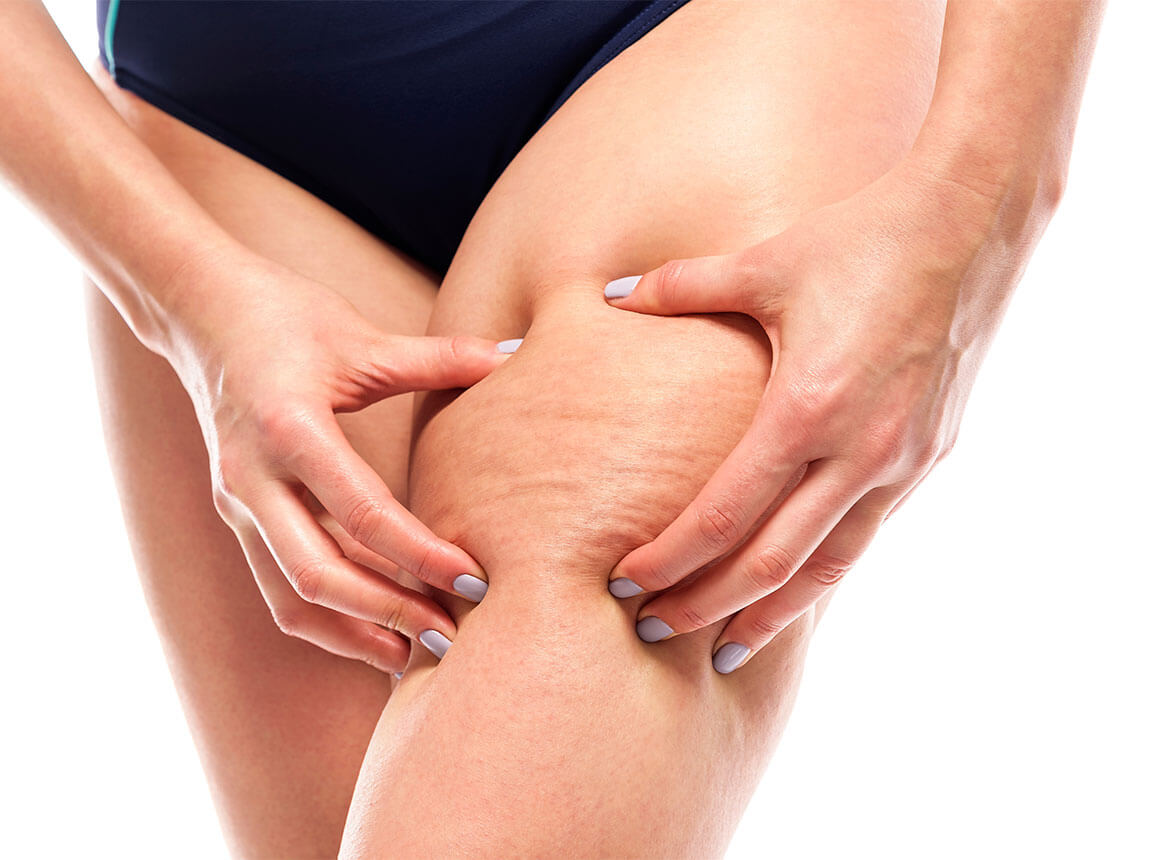 шкіра з целюлітом і без