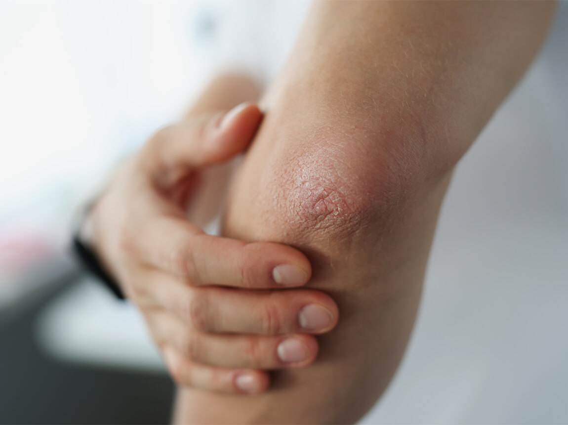 сухі лікті - зволожуючий крем 