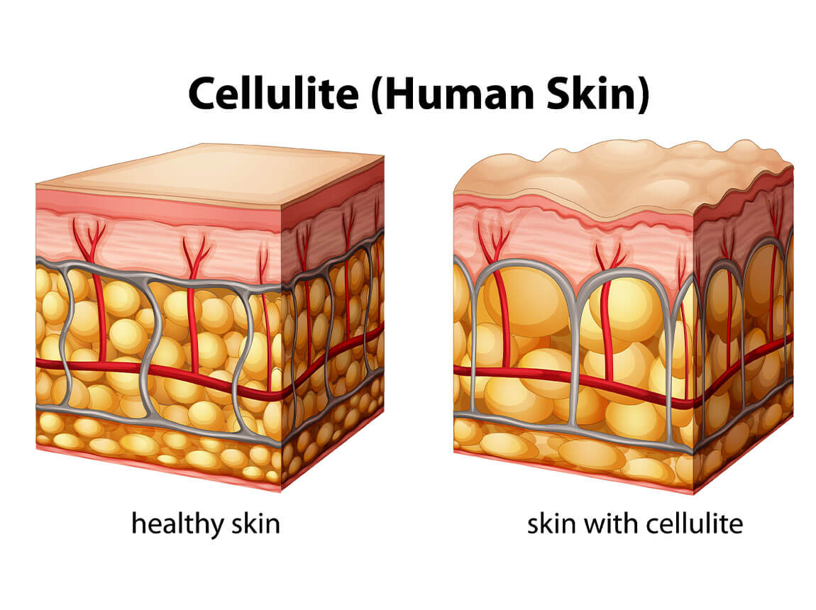 шкіра з целюлітом і без