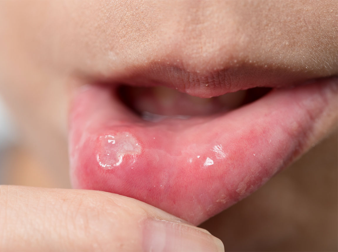 жінка - афти на губах